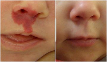 Removal of Birthmarks / Haemangioma /Portwine Stains / Vascular malfunction Removal of Birthmarks / Haemangioma /Portwine Stains / Vascular malfunction