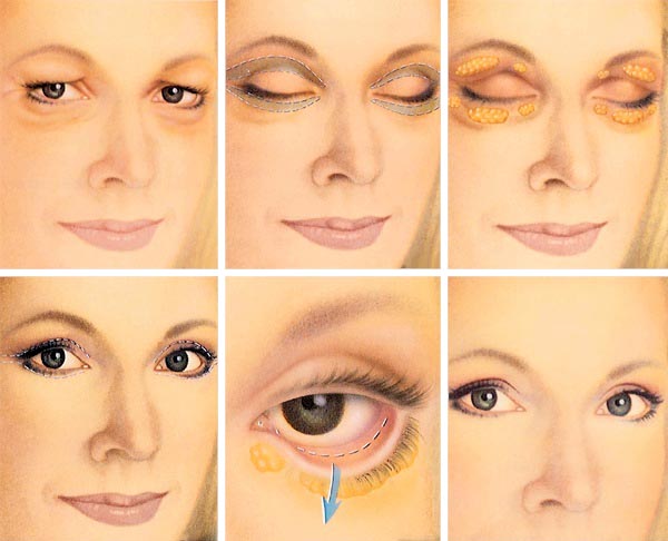 Blepharoplasty (Correction of Eeyelid Bags) Blepharoplasty (Correction of Eeyelid Bags)