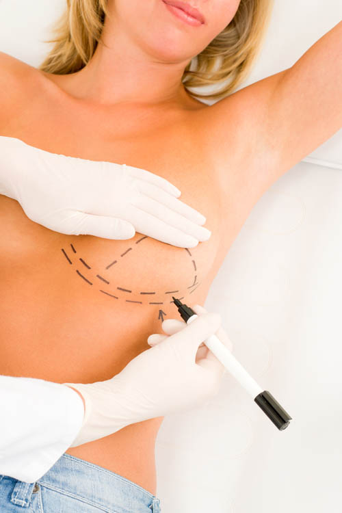 Breast Lift Surgery / Breast Firming / Mastopexy Breast Lift Surgery / Breast Firming / Mastopexy