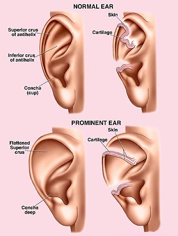 Otoplasty / Prominent (Bat) Ear Correction / Ear ReShaping Otoplasty / Prominent (Bat) Ear Correction / Ear ReShaping
