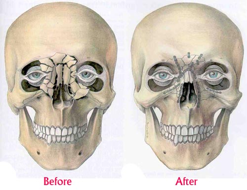 Facial Fracture After Before Facial Fracture