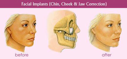 Facial Implants (Chin, Cheek & Jaw Correction) Facial Implants (Chin, Cheek & Jaw Correction)