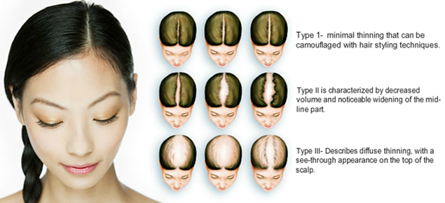 Female Pattern Baldness Female Pattern Baldness