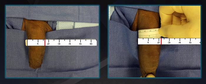 Penile Length / Girth Enhancement Penile Length / Girth Enhancement