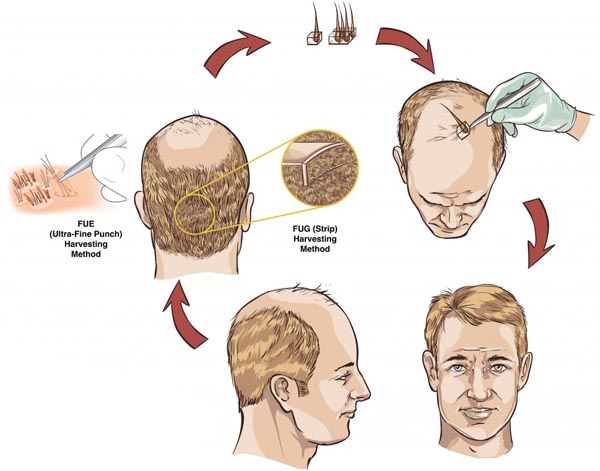 Hair Transplant Surgery Hair Transplant Surgery