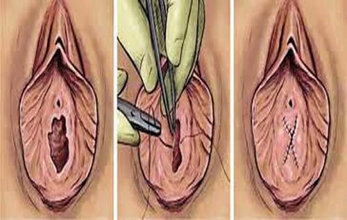 Hymenoplasty (Hymen Repair Surgery, Re-virgination) Hymenoplasty (Hymen Repair Surgery, Re-virgination)