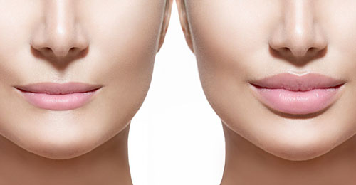 Lip Augmentation Lip Augmentation