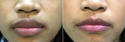 Lip Reduction / Reshaping Lip Reduction / Reshaping