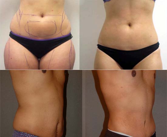 Liposuction – Body Shaping Liposuction – Body Shaping