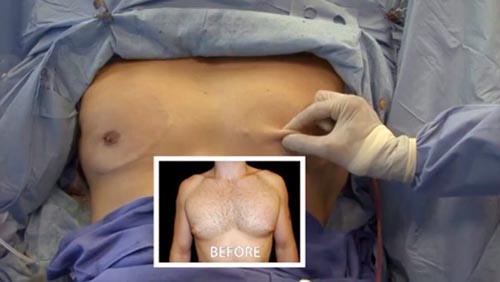 Puffy Nipples / Areolae in Men Puffy Nipples / Areolae in Men