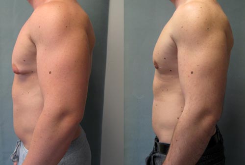 Gynecomastia (Correction of enlarged male breast) Gynecomastia (Correction of enlarged male breast)