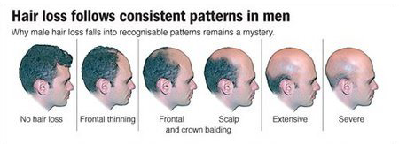 What is Male Pattern Baldness ? What is Male Pattern Baldness ?