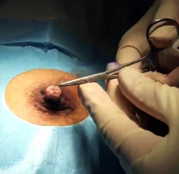Correction of Inverted Nipple Correction of Inverted Nipple