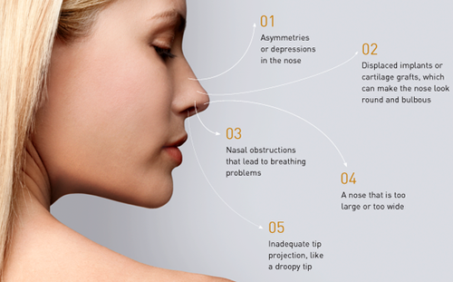 Nose Reshaping (Rhinoplasty) Nose Reshaping (Rhinoplasty)