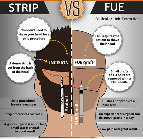 Hair Transplant Methods Strip vs FUE Hair Transplant Methods Strip vs FUE