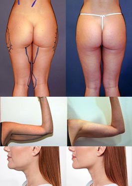 Liposuction – Thighs & Buttocks Liposuction – Thighs & Buttocks