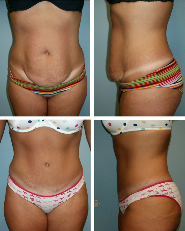Abdominoplasty – Tummy Tuck Abdominoplasty – Tummy Tuck in Patiala