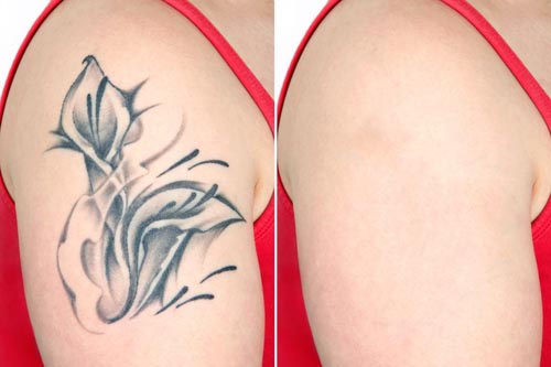 Tattoo Removal Tattoo Removal